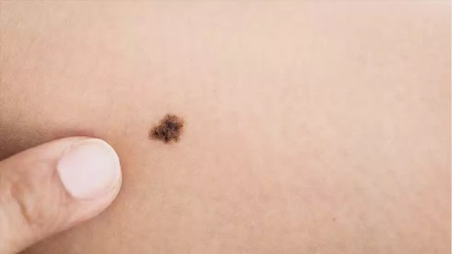 Câncer de pele: pesquisa testa novo tratamento que pode reduzir tumores sem cirurgia invasiva